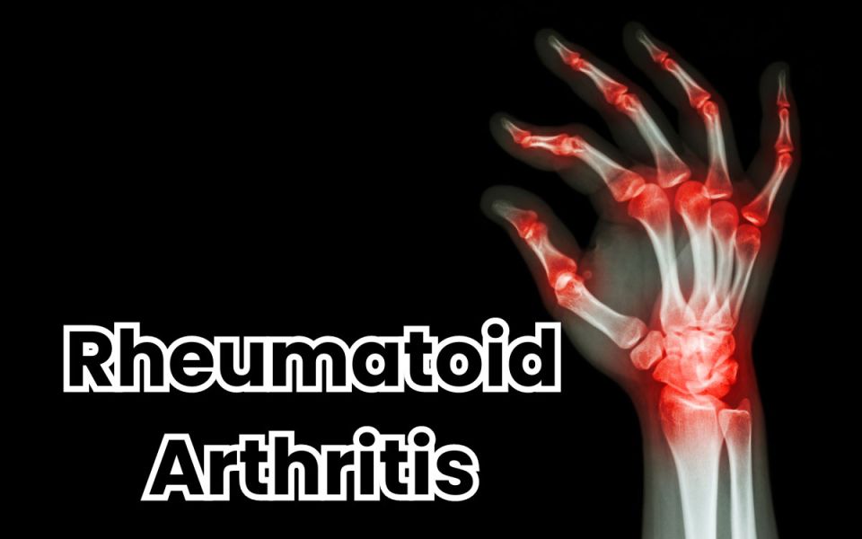 Rheum for Improvement: Tackling Rheumatoid Arthrit...
