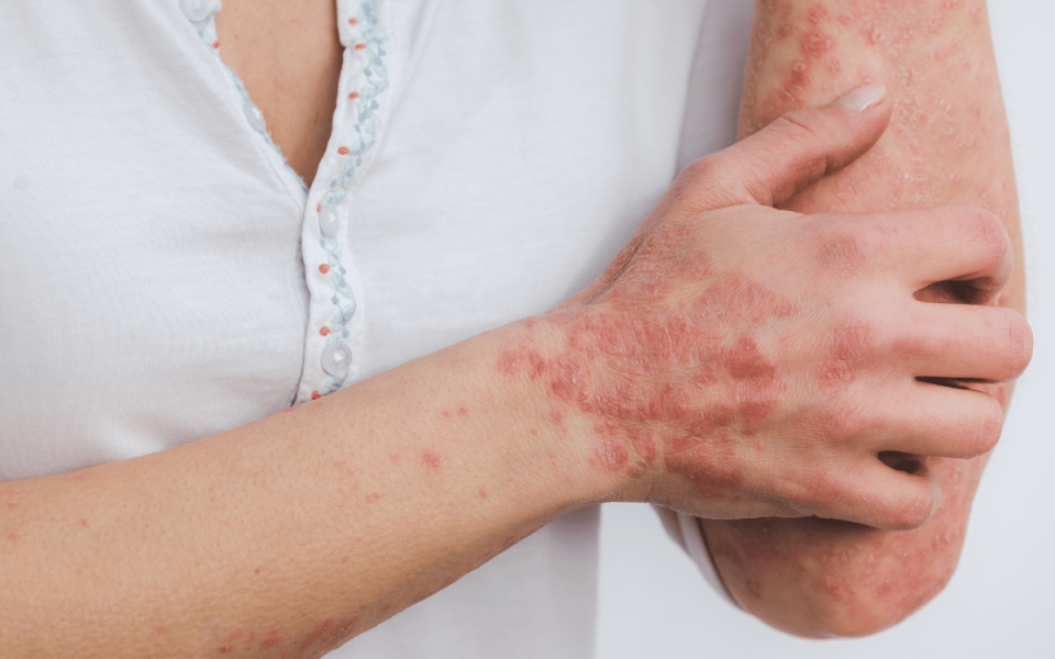 Inside the Inflammatory Cascade: Understanding Psoriasis