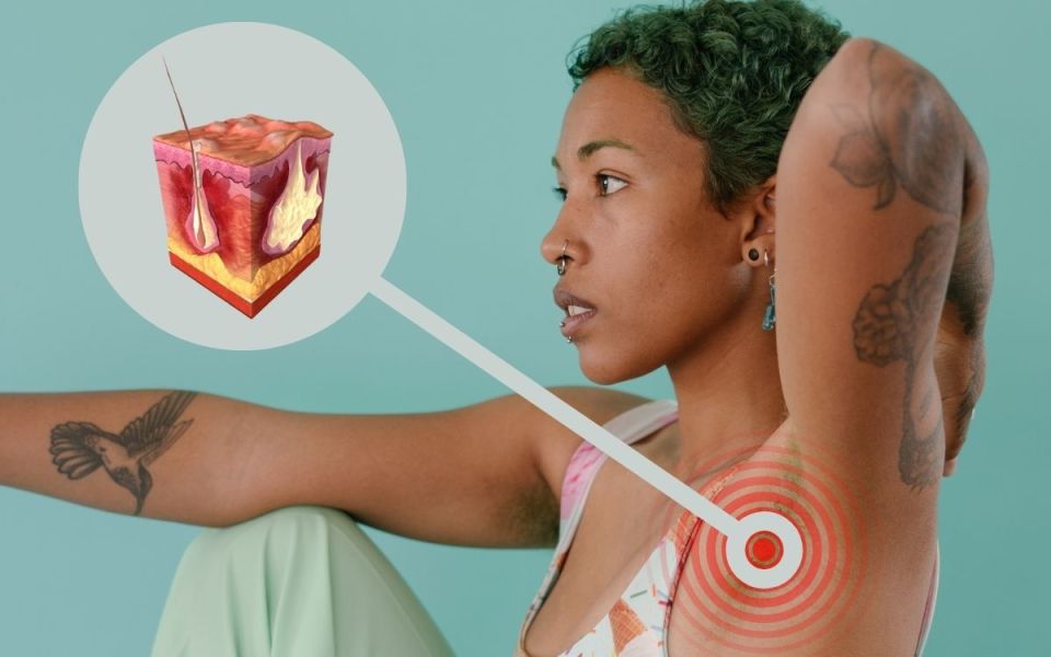 Beneath the Surface of Hidradenitis Suppurativa